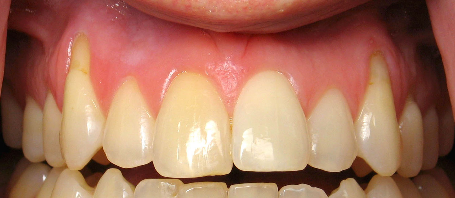 How Do I Reverse Gum Recession