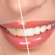 teeth whitening new westminster