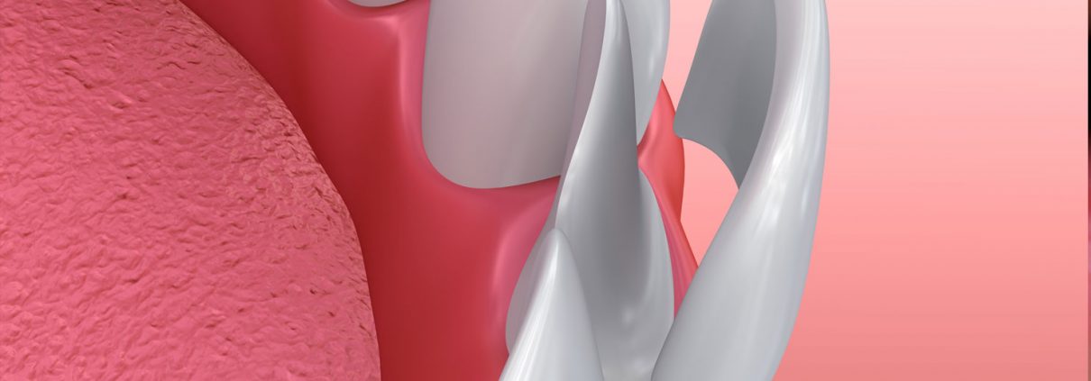 Illustration of a porcelain veneer being placed on a front tooth