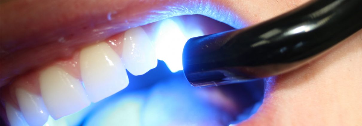 Curing light hardening a tooth-coloured filling
