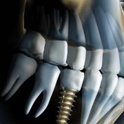 dental implants new westminster