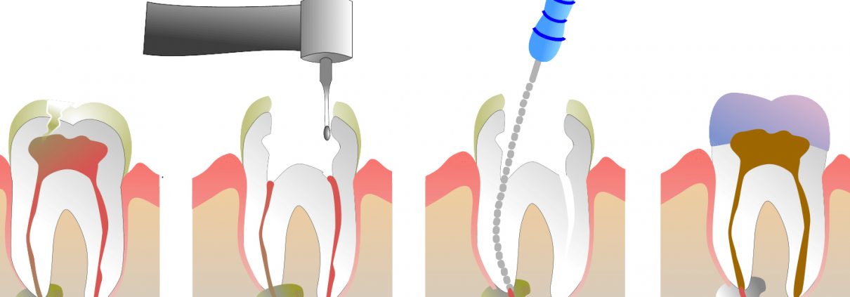 Illustration of the steps of root canal treatment