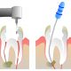 root canal new westminster