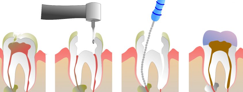 root canal new westminster