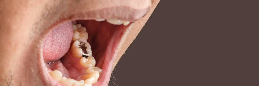 new westminster dentist filling
